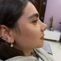 جشنواره جراحی بینی۳۷میل