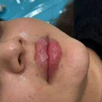 جشنواره با50٪ آف بهاره فیلر و بوتاکس