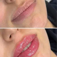 ژل و بوتاکس و لیزر در مطب با قیمت استثنایی