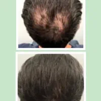 محلول موضعی رویش کاملاتضمینی