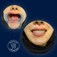 لابراتوار دندانسازی دنتالین.مشهد.روکش.مصنوعی.لمینت