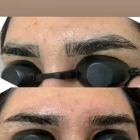 پاک کردن تاتو، کربن تراپی، لیزر ضد لک