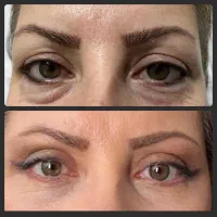 جشنواره تخفیف بلفاروپلاستی