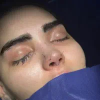 جراحی زیبایی بینی