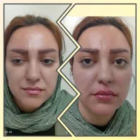 50%تخفیف شرایط اقتصادی لیزر و زیبایی درماپریس