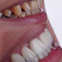 دندانسازی،دندان مصنوعی متحرک،روکش ثابت،بریج سرامیک