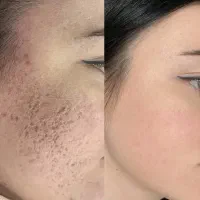 میکرونیدلینگ صورت