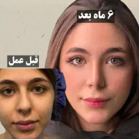 چجراحی زیبایی بینی در تهران/ویژه مراجعین محلات/43