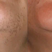 تنها کلینیک لیزر تضمینی موهای زائد بدن در سبزوار
