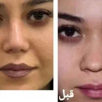لیفت بینی در خانه به صورت کاملا گیاهی و طبیعی