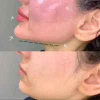 ژل و بوتاکس