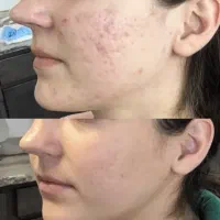آف ویژه به مدت محدود پاکسازی پوست