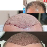 جشنواره کاشت مو در قم