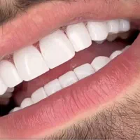 کامپوزیت دندان با بهترین مواد و متریال