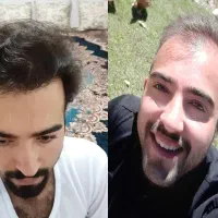 کلینیک تخصصی کاشت مو کاشت ابرو