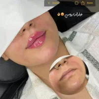 خدمات تخصصی فیلر صورت و بوتاکس
