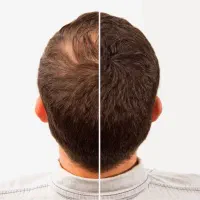 نانو تراپی(دوره تخصصی درمان ۴۵ روزه مو)