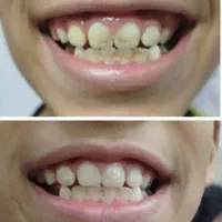 اسپری ضد پلاک و سفیدکننده آریا (تضمینی)