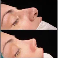 عمل جراحی بینی.لیفت صورت گوش،اندام