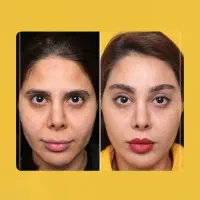 لیفت لب ها ، سانترال لب ، کاملا طبیعی و نچرال - اقساط در شیراز، زرگری، خ ستار خان بیستم