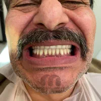 اووردنچر / دست دندان / ایمپلنت / دندانپزشکی VIP