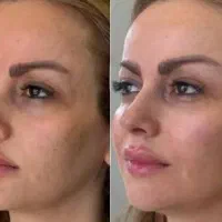 جشنواره ویژه بوتاکس و فیلر بادی و بیکینی و سینه