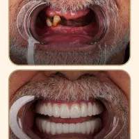 دندانپزشکی ایمپلنت تخصصی