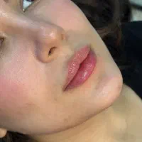 جشنواره ٪۵۰ کانتورینگ و فیلر و ژل و بوتاکس