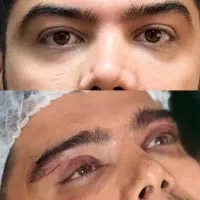 عمل بینی بلفا رو پلاسی لیفت ۳۶۰ صورت