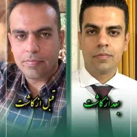 کاشت مو با تراکم بالا مشاوره رایگان
