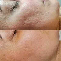 تخفیف ویژه بوتاکس پی ار پی مزوتراپی مزوژل لوکسیوا