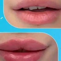فیلروبوتاکس