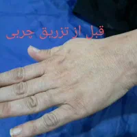 ژل بوتاکس لیزر (تخفیف واقعی)