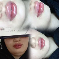 جشنواره تخفیف تزریق ژل هر سی سی ۷۹۹و بوتاکس