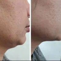 جوانسازی تخصصی ، فرکشنال هایفو ، رفع غبغب