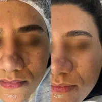 جشنواره تابستانه فیشال هایفو کربوکسی لیزر ونوس