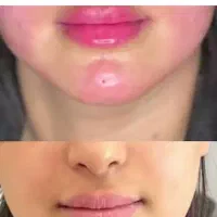 تزریق ژل،بوتاکس،prp،مزوژل ها