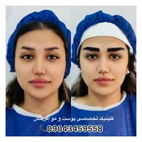 کاشت ابرو طبیعی فقط با ۲۲ میلیون دو قسطه
