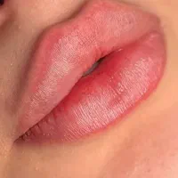 تزریق ژل لب و مادلینگ.گونه.چانه .خط لبخند