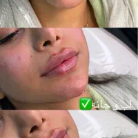 تزریق ژل لب بوتاکس ۳۰٪ اف ویژه جشنواره