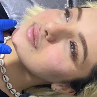 ژل و بوتاکس(مدل)
