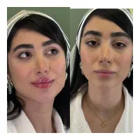 ژل لب۲۸۵۰بوتاکس۱۲۵۰درمرکزی معتبر(توسط پزشک)
