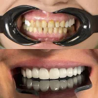 دندانپزشکی دیجیتال/عصب کشی/روکش دندان/ترمیم/جراحی