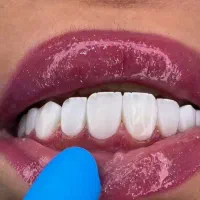کامپوزیت طرح تابستانه