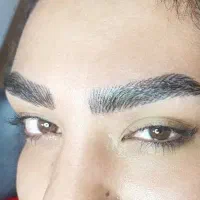 فیبروز و تزریقات زیبایی