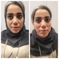 بوتاکس.  فیلر . کانتورینگ