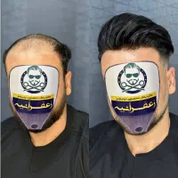 پروتزموپرپشتی مو بدون عمل و دردوخونریزی باضمانت