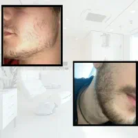 دوره پرشتی ریش