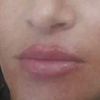 مزوبوتاکس فیلر