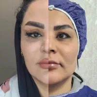 بلفاروپلاستی با بخیه لیزری ۷.۹۹۰